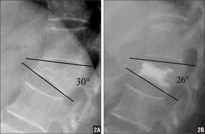 Spinal Compression Fracture X-Ray