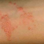 External First Aid – Poison Ivy Rash