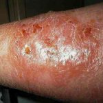 External First Aid – Poison Oak Extreme Rash