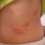 External First Aid – Poison Oak Rash